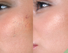 Get rid of spider veins on the face