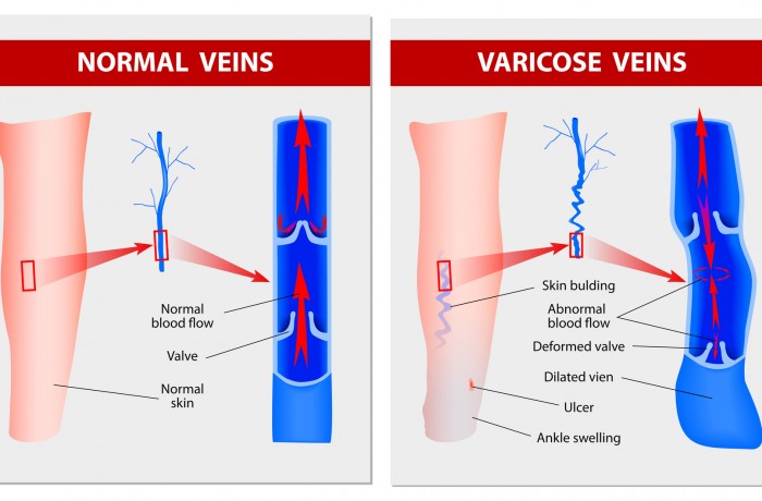 About varicose veins